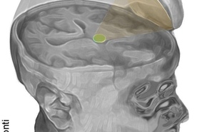 Мозг пробудили от комы с помощью ультразвука