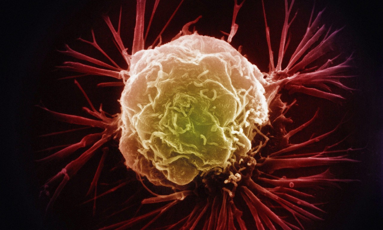 Изображение раковой клетки злокачественной опухоли молочной железы