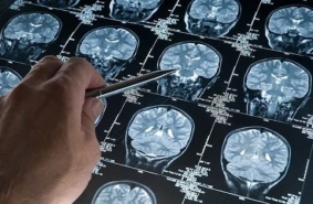 Светозвуковая терапия замедлила развитие болезни Альцгеймера
