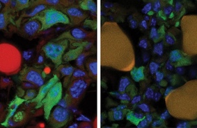 Превращение раковых клеток в жировые может остановить распространение метастазов