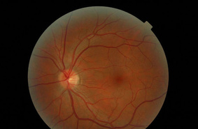 Учёные вырастили из перепрограммированных клеток сетчатку глаза человека для пересадки