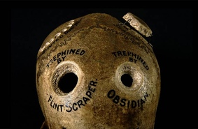 С дырочкой в левом боку: ископаемые кости рассказывают историю самой древней операции