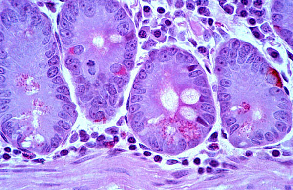 клетки Панета, болезнь Крона, заболевания кишечника, кишечник