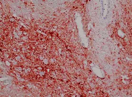 Прионы в ткани мозга больного оленя под микроскопом