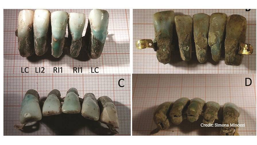 Найдена в Италии удивительная зубная коронка времен Средневековья