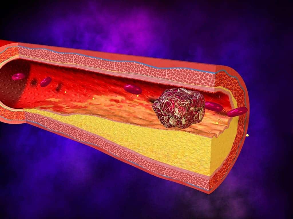 Агрегация тромбоцитов может вызвать закупорку сосудов, которая блокирует кровоток, что приводит к тромбозу